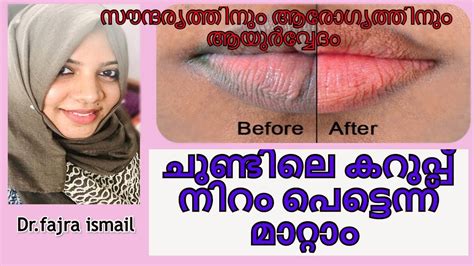 How To Remove Dark Lips And Get Soft Lips Naturally At Home Malayalam