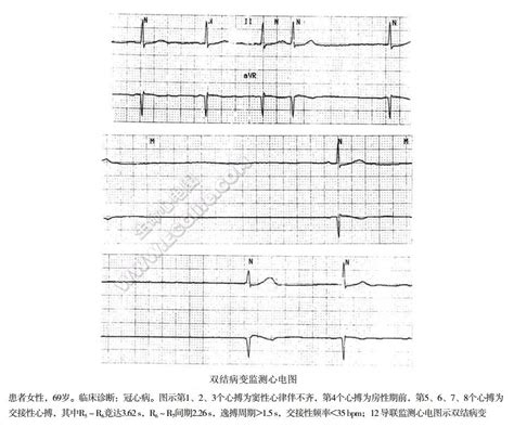 【附图】快 慢综合征心电图表现心血管综合征学 天山医学院