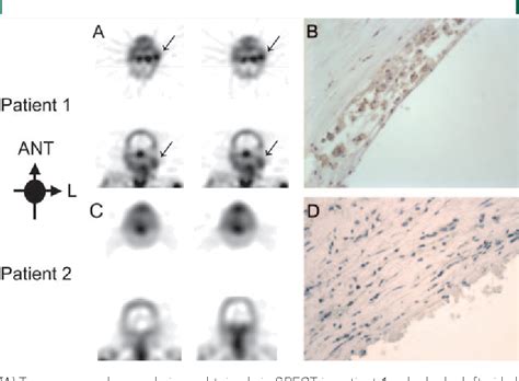 Figure 6 From Identifying Vulnerable Carotid Plaques By Noninvasive