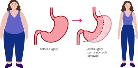 Gastric Sleeve Surgery Hertfordshire Essex Cambridge Kent