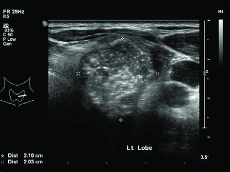 Ultrasound Of Thyroid Showing Left Thyroid Nodule Tr 5 Download Scientific Diagram