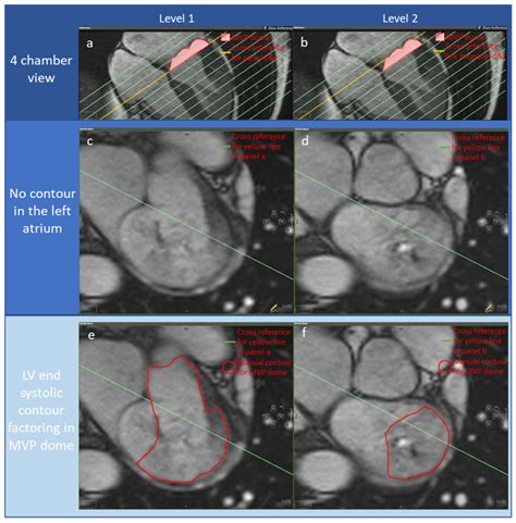 Medical Sciences Free Full Text The Importance Of Mitral Valve