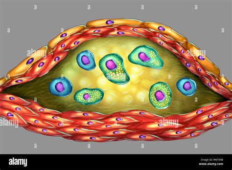 Structure Of Atherosclerotic Plaque Computer Illustration The