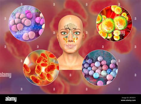 Anatomy Of Rhinosinusitis And Bacteria That Cause Sinusitis