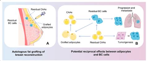 Oncologic Safety In Autologous Fat Grafting Of Breast Reconstruction A Download Scientific