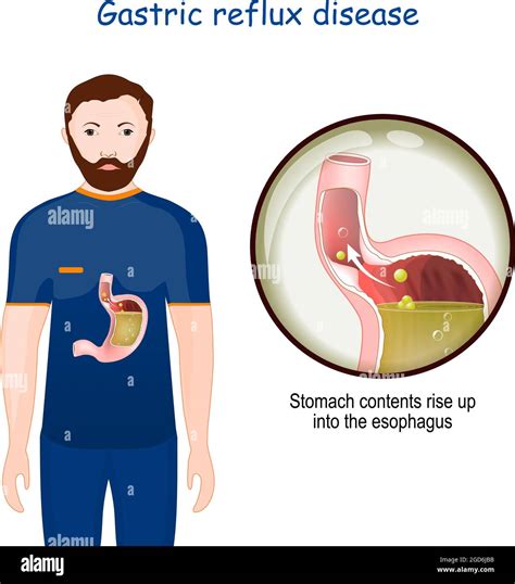 Trattamento Della Malattia Da Reflusso Gastroesofageo Immagini