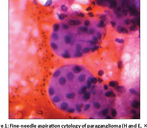 Figure 1 From Fine Needle Aspiration Cytology Of Parapharyngeal Tumors