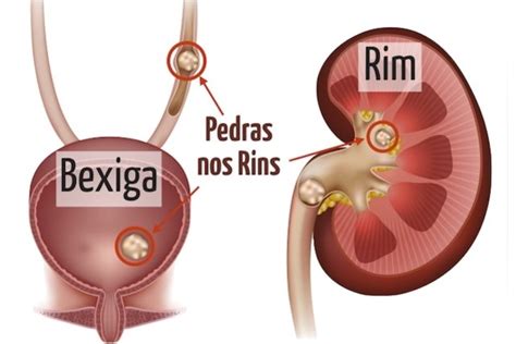 Como é uma pedra nos rins Uroclinica