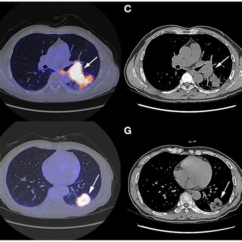 Chest CT Scan And Fused PET CT Images Of The Masses On October 9th