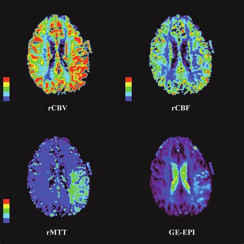 DSC Perfusion Weighted Imaging Parametric Maps DSC Perfusion Maps Are