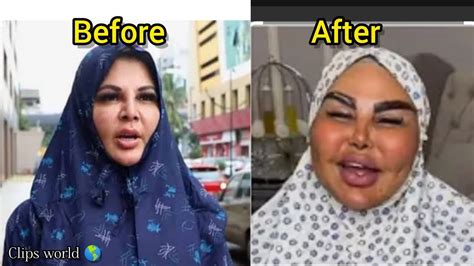 Top 10 Worst Celebrity Plastic Surgery Disasters Extreme Plastic Surgery Before After Top10