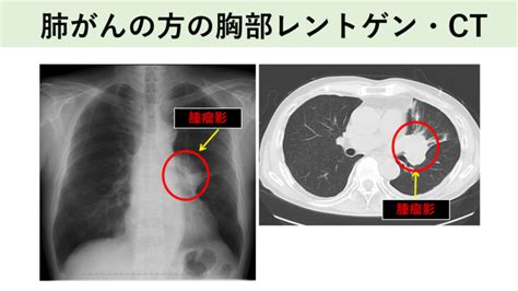 肺がんの原因・予防｜名古屋おもて内科・呼吸器内科クリニック｜荒畑駅・御器所駅