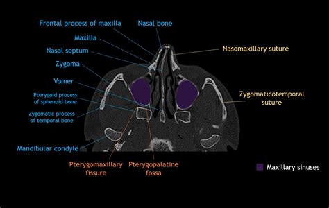 Cranial Bone Anatomy Ct Axial