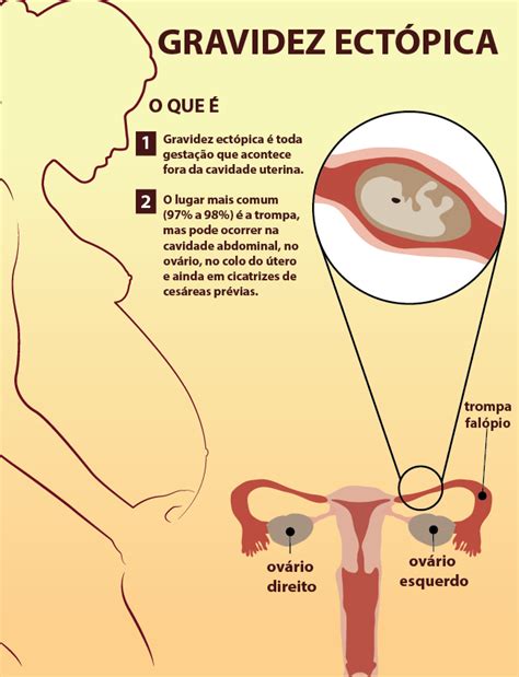 Gravidez Ect Pica Sintomas Tratamento