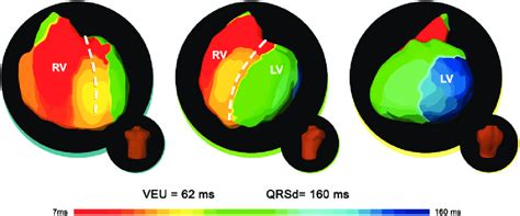 Ecgi Activation Maps Of A Clinical Responder To Cardiac Download