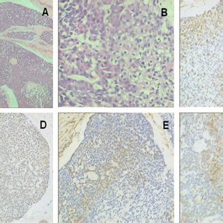 A Year Old Female Patient Diagnosed With Myoepithelial Carcinoma