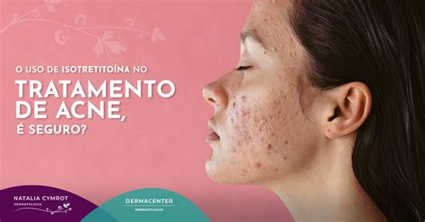 O Uso De Isotretino Na No Tratamento De Acne Seguro Cl Nica