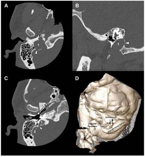 Bilateral High Riding Jugular Bulb And Jugular Diverticulum Dehiscents