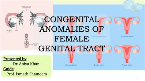 Congenital Anomalies Of Female Genital Tractpptx