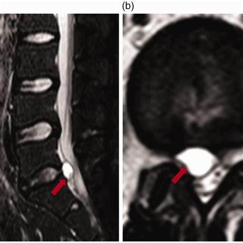 Postoperative Radiographic Findings After Weeks Showing A Cystic