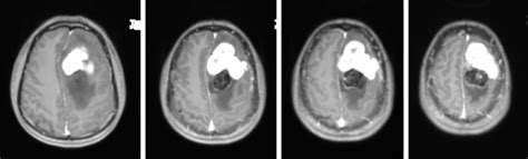 Hemangiopericytoma – Radiology Cases