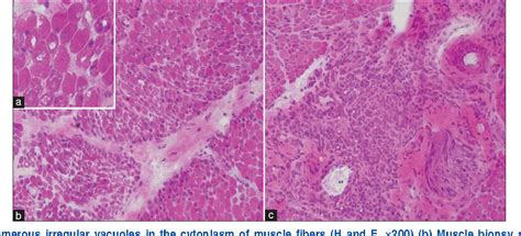 Figure From A Severe Case Of Universal Calcinosis With Juvenile