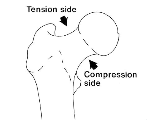 Tension And Compression Sides Of The Femoral Neck Download