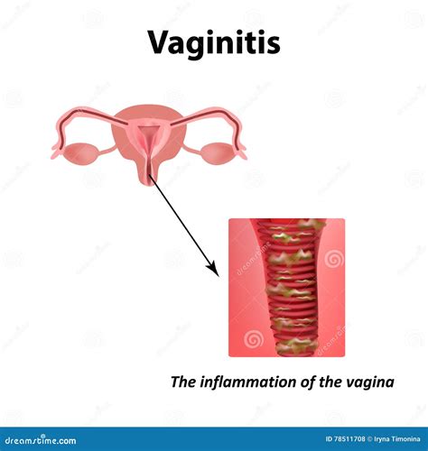 Inflammation Of The Vagina Vaginitis Infographics Stock Vector