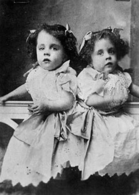 Vintage Photographs And The Tragic Life Of Conjoined Twins Daisy