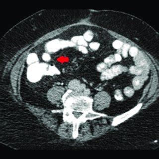 Abdominal Computed Tomography Scan The Red Arrow Shows Invagination Of