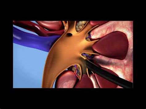 Percutaneous Nephrolithotomy YouTube