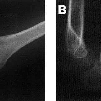 A And B Reduction And Ulnar Correction Were Performed With External