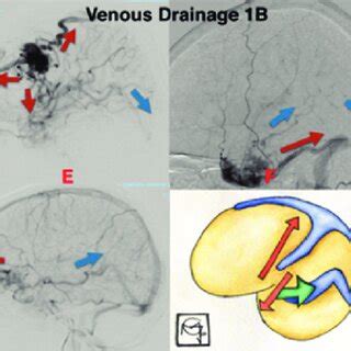 A Lateral A B And Anteroposterior Ap C Cerebral Angiogram