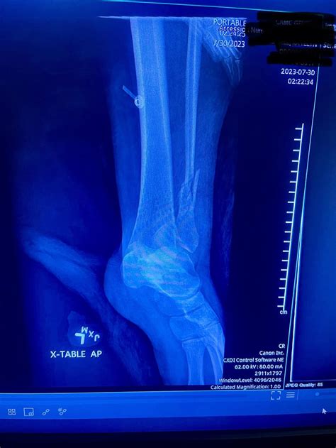 Trimalleolar Fracture With Posterior Tibial Tendonitis R Brokenbones