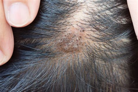 Dermatitis In Hair Or Skin Disease On The Head Stock Image Image Of Dandruff Medical 78070103