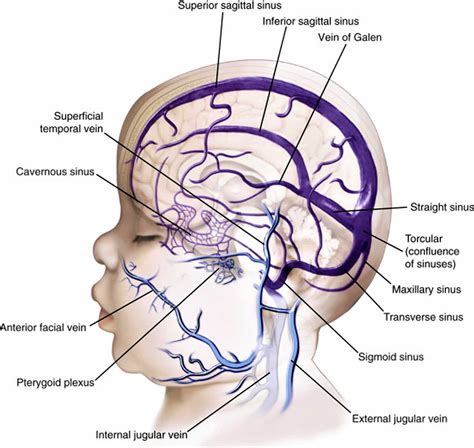 Vein of Galen malformation causes, symptoms, diagnosis, treatment & prognosis