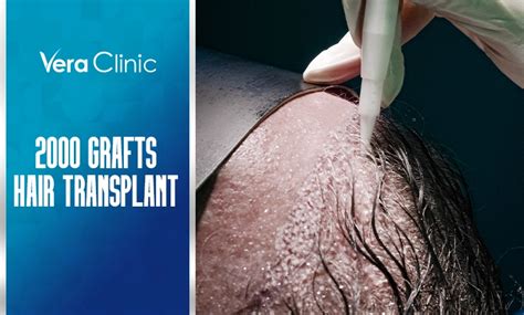A Guide To 2000 Grafts Hair Transplant Cost Vera Clinic