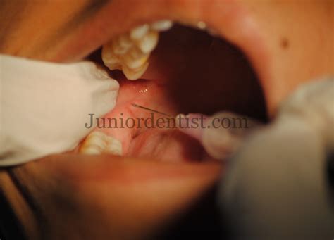 Inferior Alveolar Nerve Block Landmarks