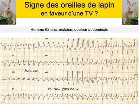 Ecg Sp Cial D Rivations E Cardiogram