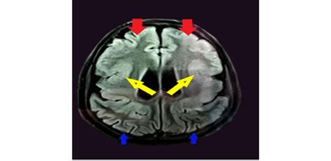 MRI Brain showing abnormally thick cerebral cortex with more pronounced ...