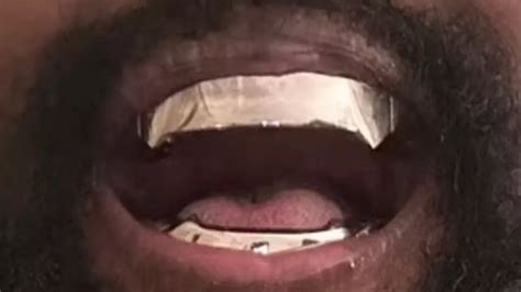 Kanye Wests New 850k Permanent Titanium Teeth Are An Attention Seeking Stunt Mirror Online