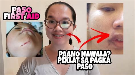 First Aid Sa Paso Sa Balat Gamot Sa Paso Para Hindi Magka Peklat