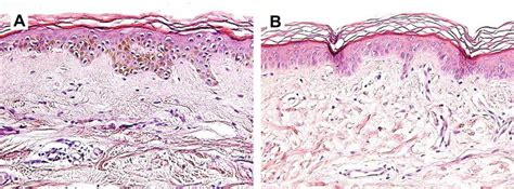 Skin Biopsy Specimen Taken Form Patient A Hyper Pigmented Lesion