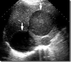 Ultrasound images of liver Amebic Abscess ~ Ultrasound Cases Info