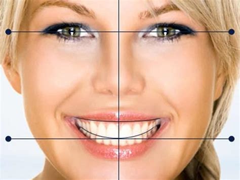 Qué es el Diseño Digital de Sonrisa Clínica Dental Manises y Paterna