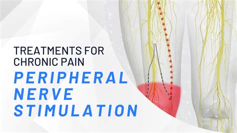 Peripheral Nerve Stimulator Sound Pain Alliance What You Need To Know