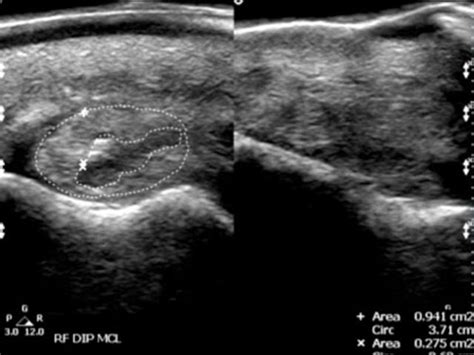 Torn Medial Collateral Ligament & How Vibration Can Help - Vitafloor