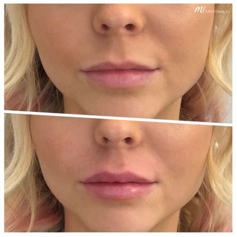 Lippen Aufspritzen Mit Hyaluron Lippenunterspritzung Bei M Z Rich