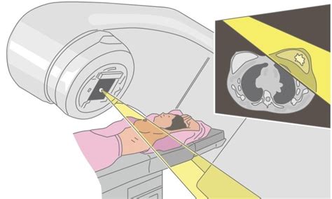 什麼是乳癌放射線治療？哪些人需要做？ 康健雜誌