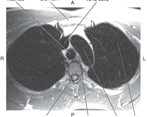 mri chest diagram quizlet
